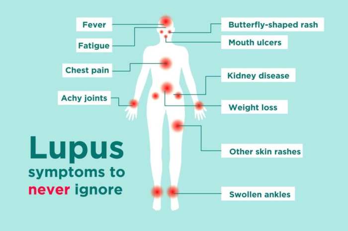 Sjögren's syndrome and lupus screening quiz