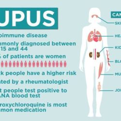 Sjögren's syndrome and lupus screening quiz