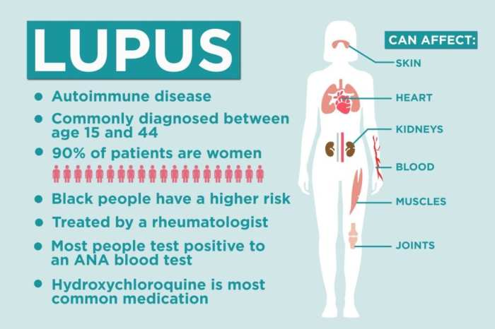 Sjögren's syndrome and lupus screening quiz